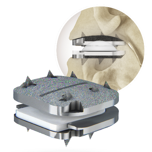 prodisc cervical disc replacement implant